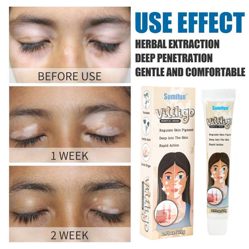 Removal Cream skin treatment